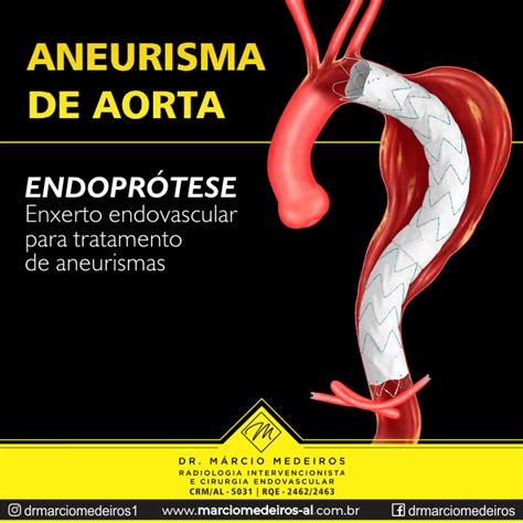 Aneurisma De Aorta Endoprótese Dr Márcio Medeiros