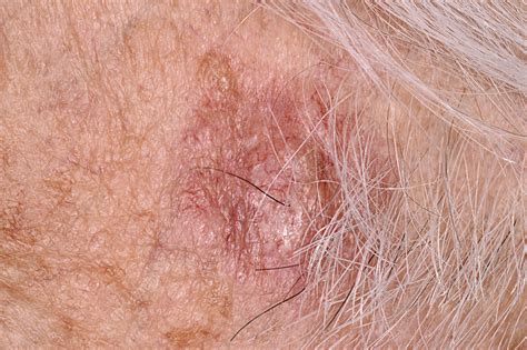 Basal Cell Carcinoma Stock Image C0401415 Science Photo Library