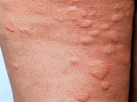 Hives Urticaria Harley Street Dermatology Clinic