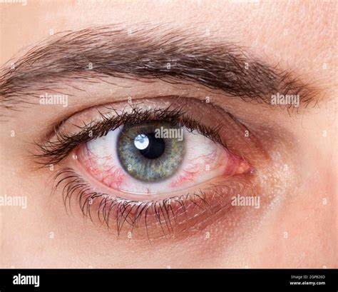 Close Up Of Irritated Red Blood Eye Stock Photo Alamy