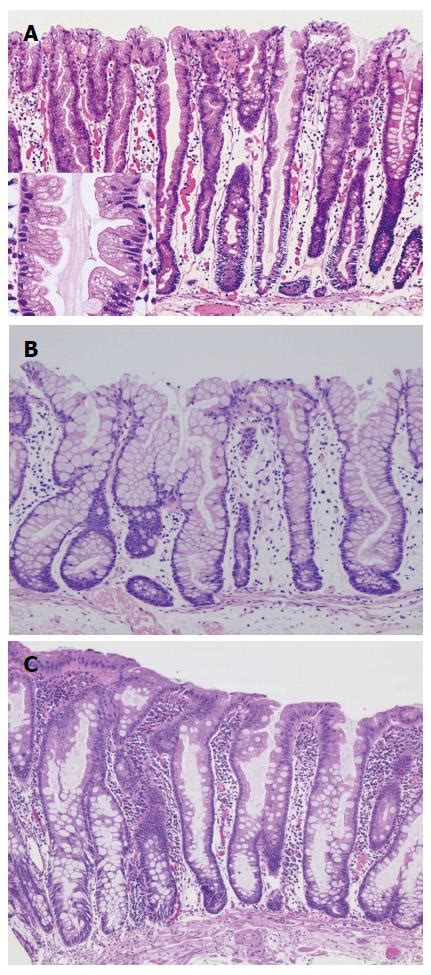 Serrated Polyps Of The Colon And Rectum Endoscopic Features Including