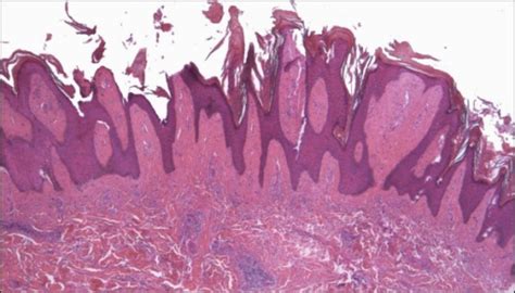 Hyperkeratotic Verrucous Kaposi Sarcoma A Plaque Sta Open I