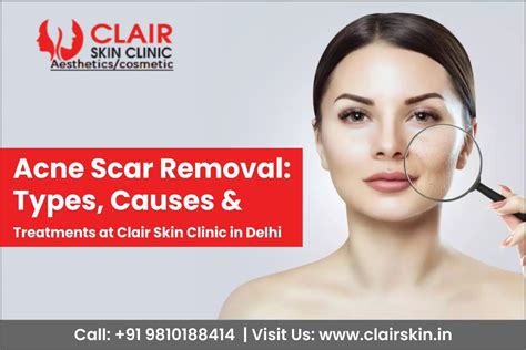 Acne Scar Removal Types Causes And Treatment At Clair Skin Clinic