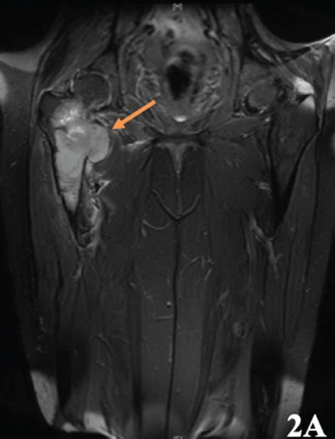 Fat Suppressed T2 Mri Of The Right Femur A Cortical Destruction With