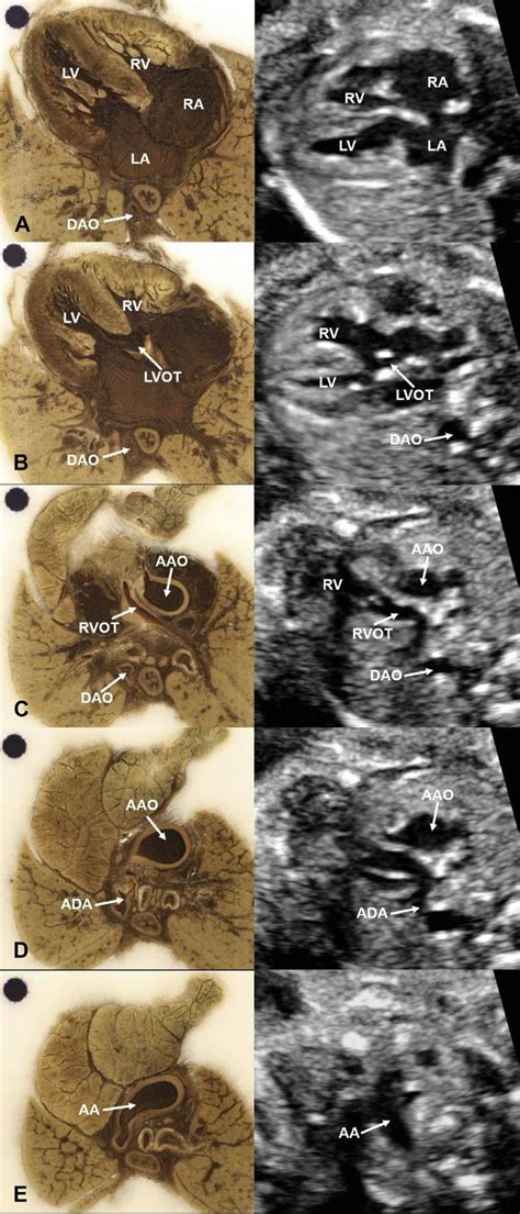 Cross Section Images Of Fetal Heart With Tetralogy Of Fallot Including
