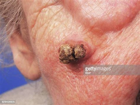 Squamous Cell Cancer Photos And Premium High Res Pictures Getty Images