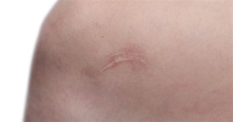 What Causes Keloid Scarring Livestrongcom