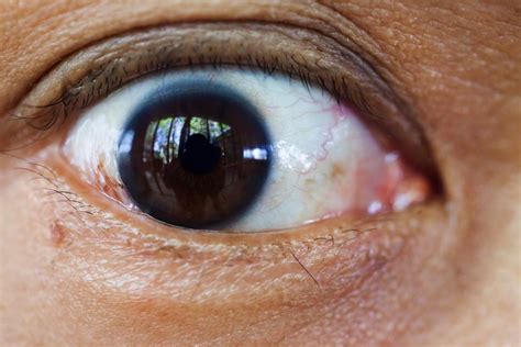 10 Signs Of Cataracts Facty Health