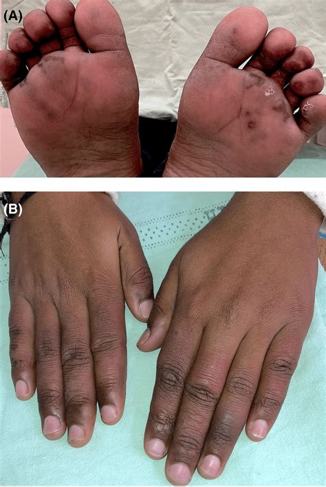 A Multiple Tender Erythematous To Purpuric Macules Over Soles B