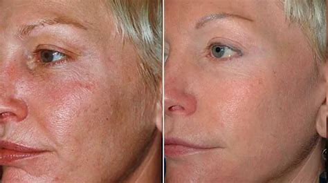 Best Laser Rejuvenation Treatment Nyc Laser Skin Rejuvenation Skin