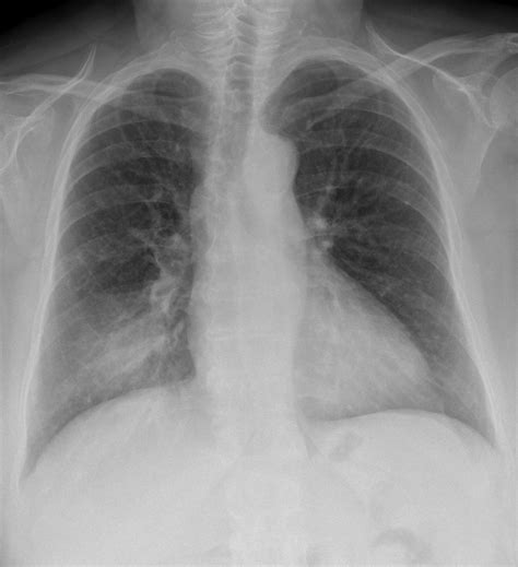 Chest X Ray Pneumonia