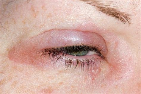 Eyelid Swelling Due To Allergy Photograph By Dr P Marazzi Science