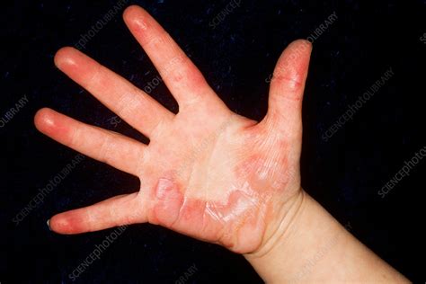 Burn Scars On Hand Stock Image C0034381 Science Photo Library