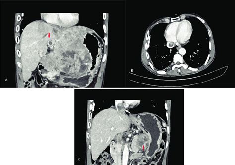 A Coronal Reformatted Intravenous Contrast Enhanced Computed