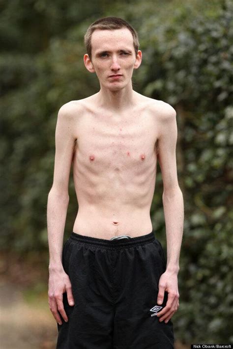 marc corn anorexic man can only eat chocolate mousse and custard after bullying made him fear