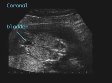 Infantile Polycystic Kidney Disease Ultrasoundpaedia