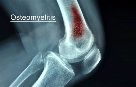 Osteomyelitis Type Cause Symptoms Treatment Mobile Physio