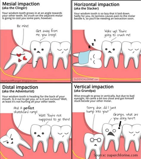 Albums 100 Images Images Of Wisdom Teeth Coming In Sharp 102023