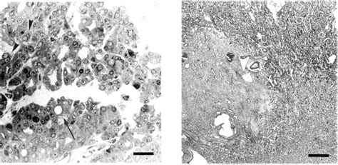 Kidney Dog Fibrous Nodule Hamartoma At The Corticomedullary