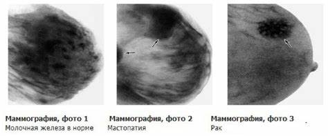 Фиброаденома молочной железы диета Фиброаденома молочной железы - лечение доброкачественной опухоли Фиброаденома молочной железы - лечение доброкачественной опухоли Фиброаденома молочной железы диета