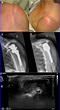Left shoulder PJI with abscess formation in an 82-year-old ...
