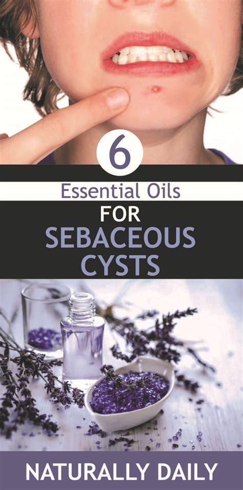 6 Essential Oils For Sebaceous Cysts Other Natural Oils For Cysts
