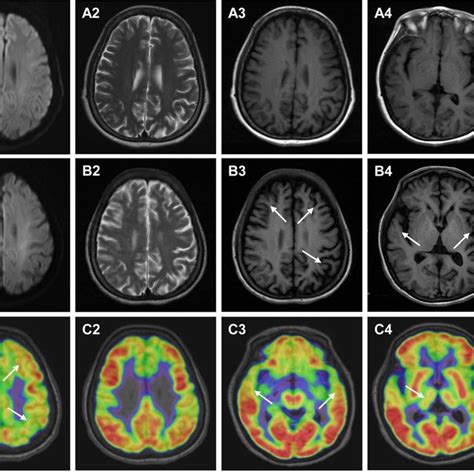 Brain Mri And ¹⁸f Fdg Petmr Examination A1 A4 First Brain Mri At