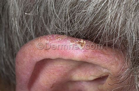 Squamous Cell Carcinoma Ear Photo Skin Disease Pictures