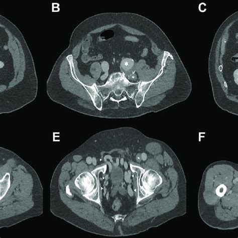 Axial Contrast Enhanced Computed Tomography Ct Scans The In Venous