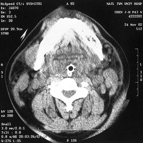 Severe Larynx Swelling Was Shown In The Head And Neck Ct After