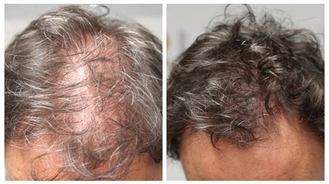 The most common type is androgenetic alopecia, which affects both men and women, but is usually more common in men. Women's Hair Loss & Scalp Micropigmentation for Women • by ...