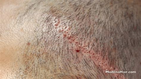 Case Study Body Hair Transplant And Strip Scar Revision