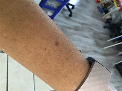 Weird Red Spot On Arm What Is It Dermatologyquestions