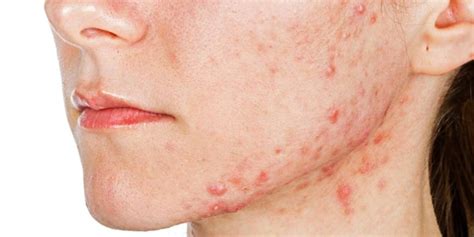 How To Stop Inflamed Acne Causes Symptoms And Treatment