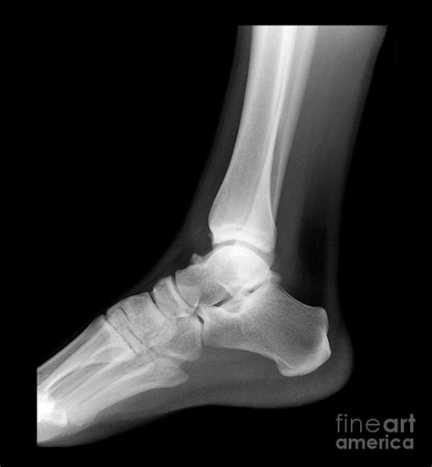 Ankle X Ray Normal Photograph By Living Art Enterprises