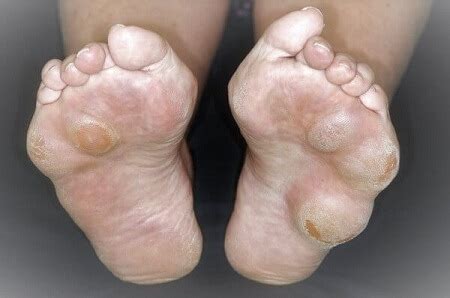 Abnormal Toe Growth