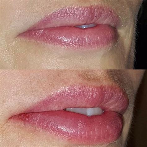 Just How Beautiful Natural Freshly Injected Lips Can Look Our Talented Nurse Injectors And