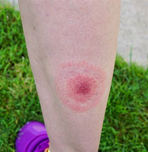 6300 Erythema Migrans Stock Photos Pictures And Royalty Free Images