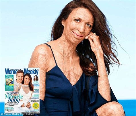Turia Pitt Reveals What She S Learned From Her Pregnancy Pregnancy