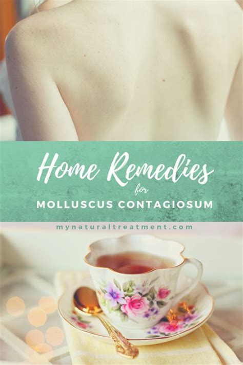 10 Amazing Home Remedies For Molluscum Contagiosum To Try