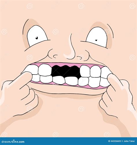 All Missing Teeth Removable Full Denture Royalty Free Illustration