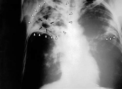 Tuberkulóza Souchotiny úbytě Příznaky Projevy Symptomy Příznaky
