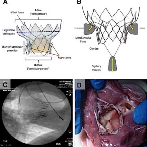 Pdf Percutaneous Transcatheter Mitral Valve Replacement An Overview