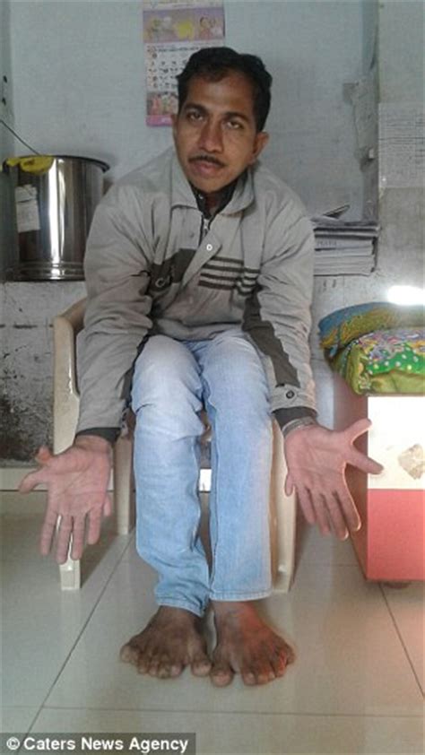 Indian Carpenter With World Record 28 Fingers And Toes In Constant Fear