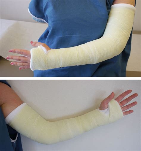 Care Of Casts And Splints Orthoinfo Aaos Hot Sex Picture