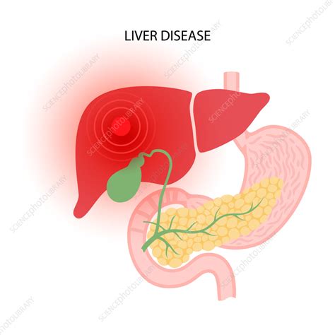 Liver Disease Illustration Stock Image F0361482 Science Photo