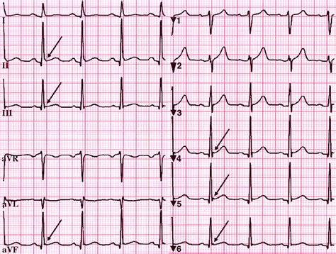 Early Repolarization Syndrome Is It Always Benign International