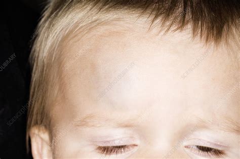 Large Bump On Forehead