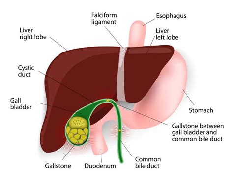 Gallbladder Inflammation Symptoms Signs Duration Complications