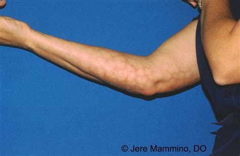 Erythema Ab Igne American Osteopathic College Of Dermatology Aocd